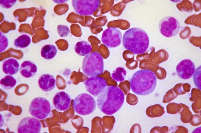 STAT+: Terns leukemia drug could succeed Novartis blockbuster