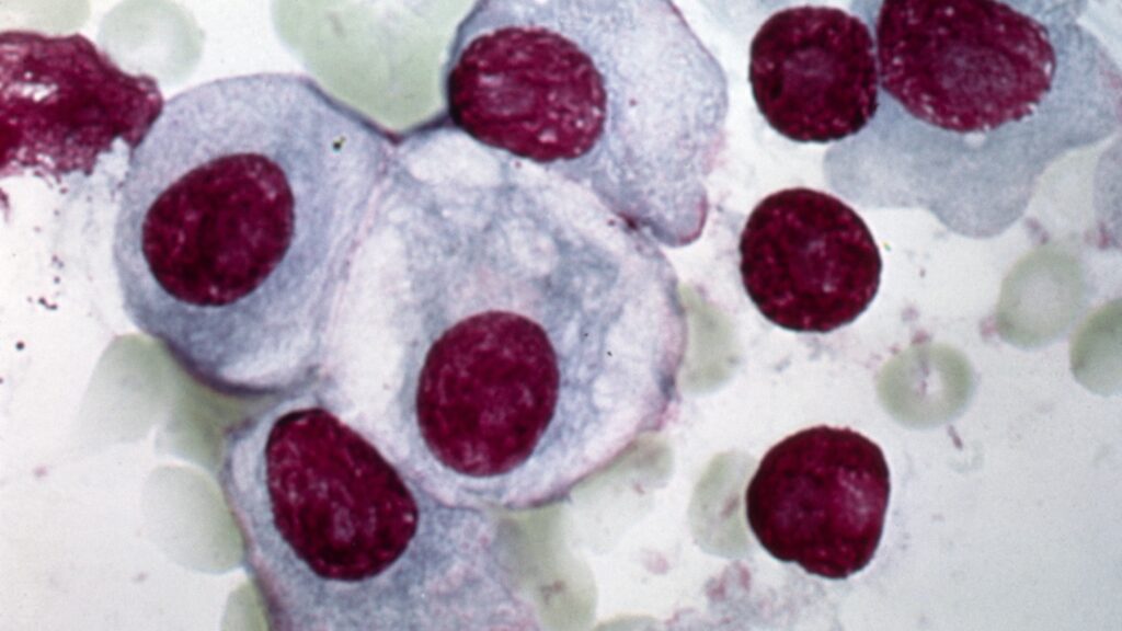 STAT+: A promising sickle cell pill and a new way to treat myelofibrosis