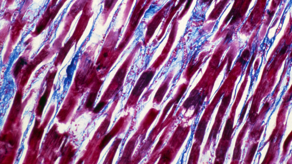 Myocarditis is a rare but real Covid vaccine side effect. A new study sheds light on what causes it