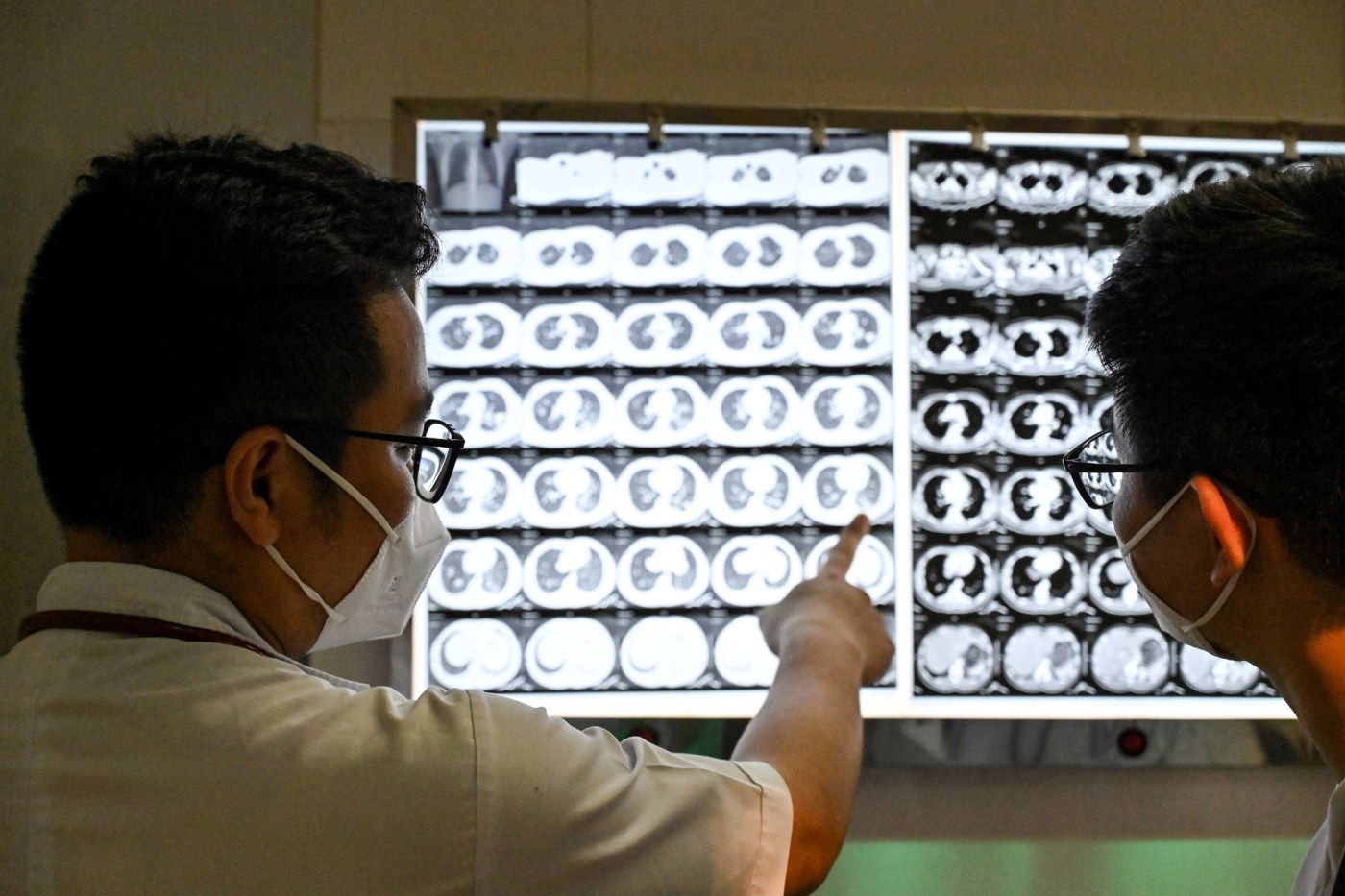 What to know about tuberculosis in the Bay Area after outbreak at high school