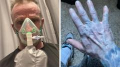Man’s blue skin A&E panic was just bed sheet dye